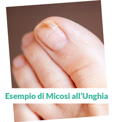 Trattamento Onicomicosi a Napoli