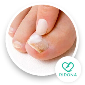 Trattamento Onicomicosi a Napoli