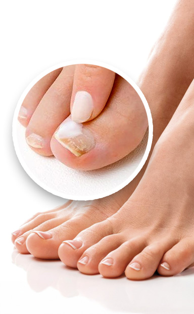 Trattamento Onicomicosi a Napoli