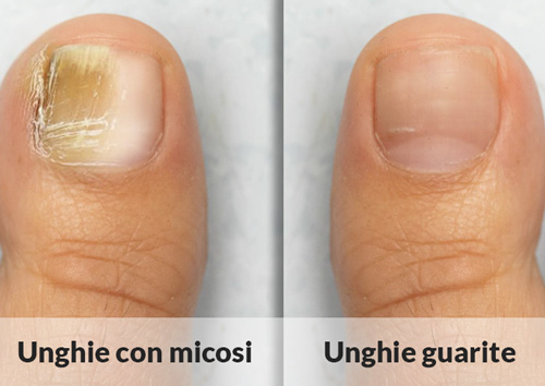 Trattamento Onicomicosi a Napoli