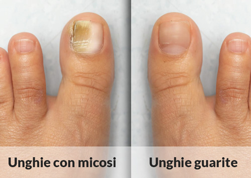 Trattamento Onicomicosi a Napoli
