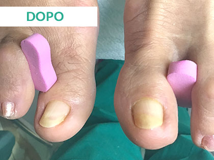 Trattamento Onicomicosi a Napoli - Dopo