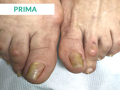 Trattamento Onicomicosi a Napoli - Prima