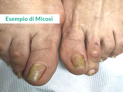 Trattamento Onicomicosi a Napoli - Prima