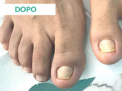 Trattamento Onicomicosi a Napoli - Dopo