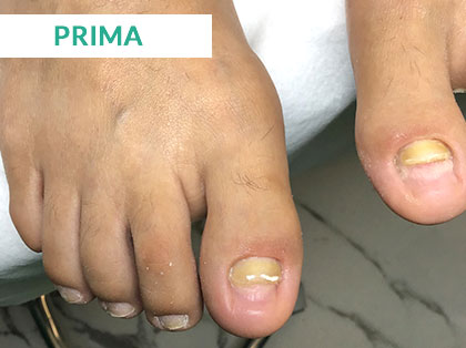 Trattamento Onicomicosi a Napoli - Prima