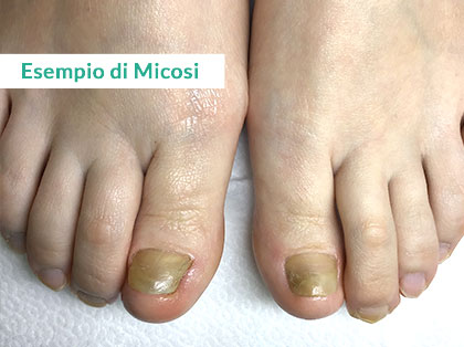 Trattamento Onicomicosi a Napoli - Prima