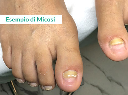 Trattamento Onicomicosi a Napoli - Prima